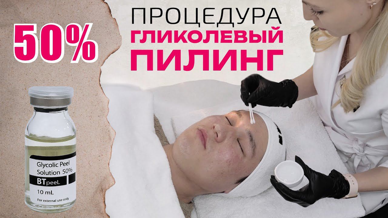 Процедура Гликолевый пилинг 50% смотреть онлайн