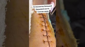 ОСТЕОСИНТЕЗ БОЛЬШЕБЕРЦОВОЙ КОСТИ. Снятие швов. Перелом большой берцовой кости. остиосинтез голени
