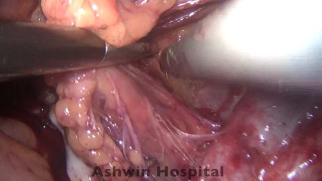 Laparoscopic Pelvic Lymph Node dissection смотреть онлайн