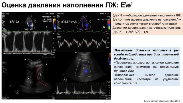 ГиП занятие 4 - диастолическая дисфункция и СНсФВ