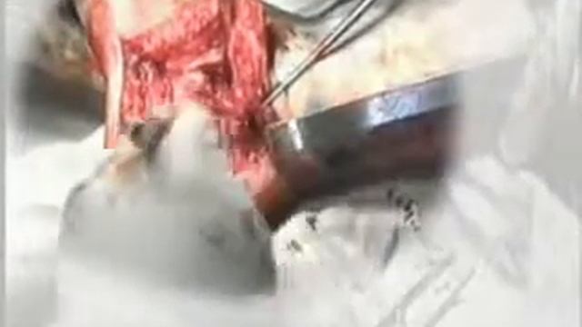 Имплантаты с памятью формы при плоскостопии и переломах пяточной кости смотреть онлайн