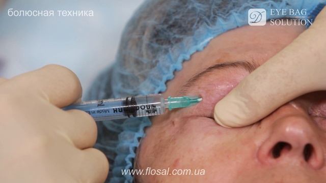 Правильная техника введения Dermaheal Eyebag Solution [ FloSal ]