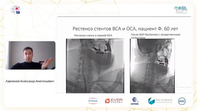 Стеноз в брахиоцефальном стволе и устье левой ОСА: что делать?! к.м.н. Ларионов А.А. смотреть онлайн