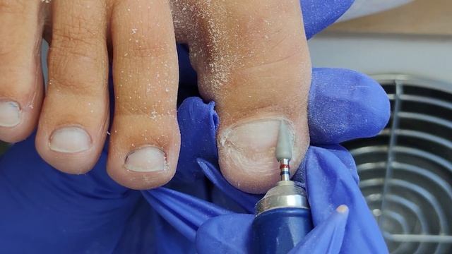 ПОЗЕЛЕНЕЛ НОГОТЬ, ЧТО ДЕЛАТЬ? ПЛЕСЕНЬ ПОД НОГТЯМИ. ОНИХОЛИЗИС НА НОГАХ. БОЛЯТ НОГТИ НА НОГАХ смотреть онлайн