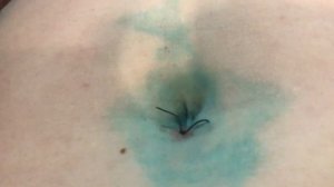 Снятие швов после лапароскопии