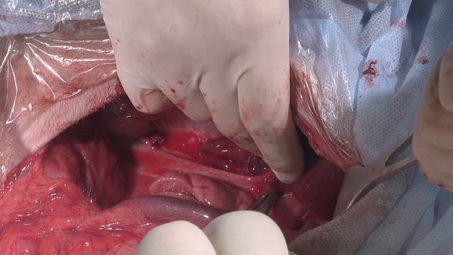 Шунт в печени поиск на с дуге и в конце его закрытие. смотреть онлайн