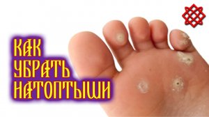 Как легко избавиться от натоптышей и мозолей. Лечение натоптышей народными средствами.mp4