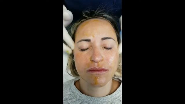 Face Protocol BioRePeelCl3 FND