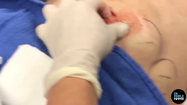 The Treasure Trove Of Lipomas