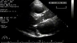 Недостаточность аортального клапана. Эхокардиография © Aortic valve insufficiency. Echocardiography