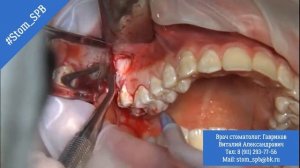 Удаление ретенированного зуба мудрости. Стоматолог Гавриков Виталий Александрович