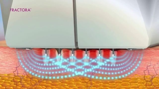 Fractora  фракционный лифтинг