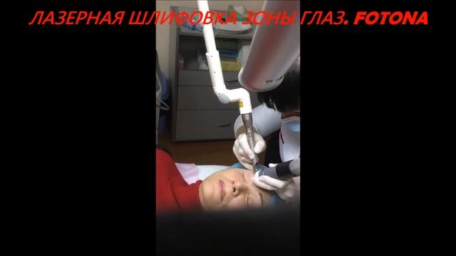 Лазерная шлифовка зоны вокруг глаз Салон Лилу в Кременчуге смотреть онлайн