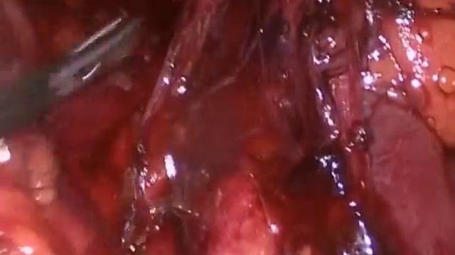 Лапароскопическая герниопластика с фиксацией клеем смотреть онлайн