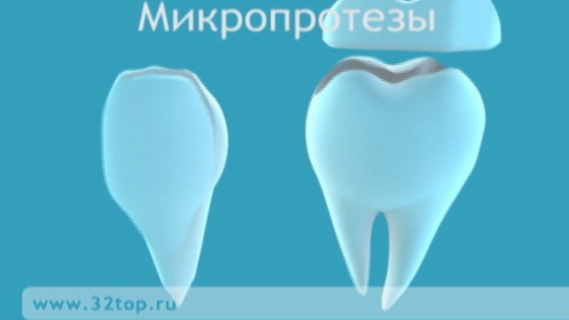 Зубные протезы. Виды зубных протезов