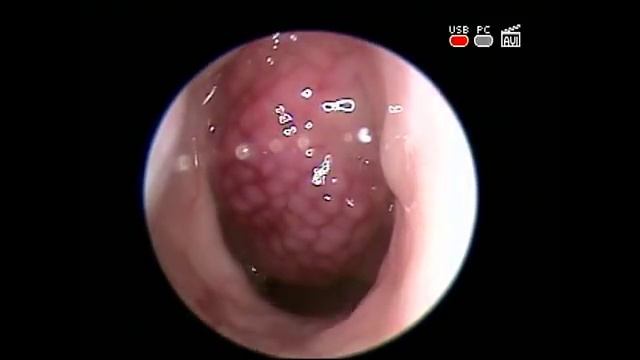 Пульсирующий аденоид смотреть онлайн