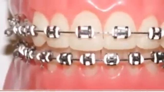 Braces Colors Ideas 2!