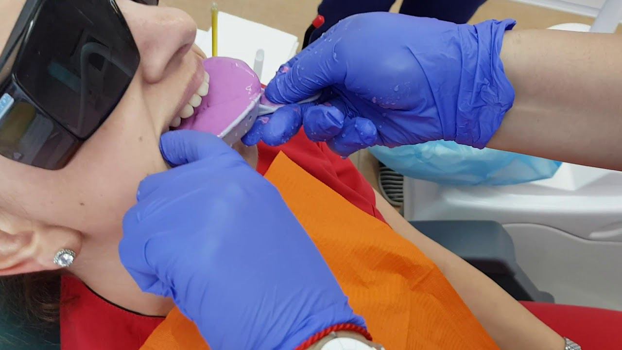 Снятие зубного слепка (оттиска) с челюстей