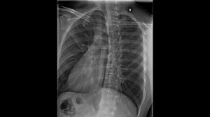 Укладка для снимка грудины