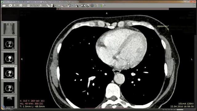 КТ надпочечников