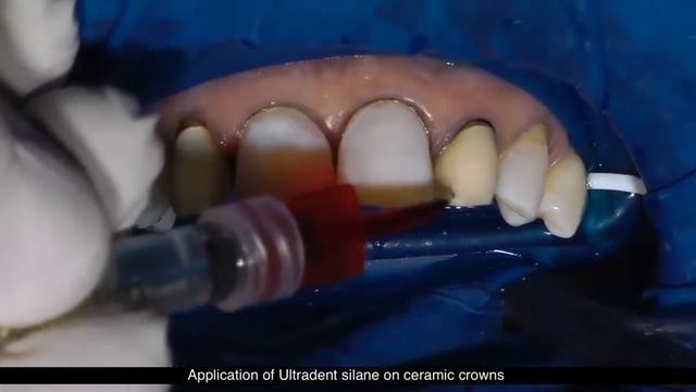 Эстетическая реставрация зубов композитными накладками смотреть онлайн