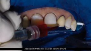 Эстетическая реставрация зубов композитными накладками