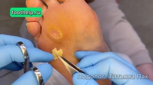 В каких слоях кожи образуется стержневая мозоль. Удаление мозоли полностью с корнем