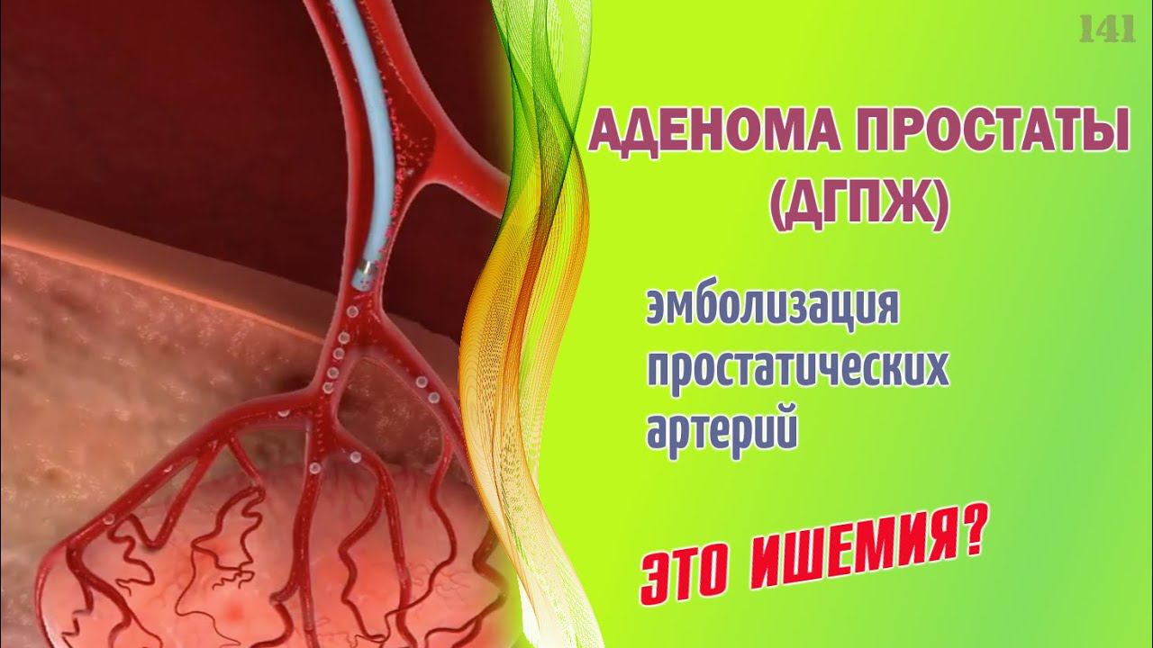 Аденома простаты. Лечение эмболизацией артерий. Это ишемия? смотреть онлайн