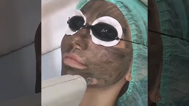 Карбоновый пилинг смотреть онлайн