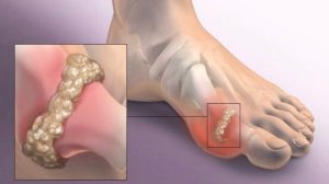 Почему болят большие пальцы на ногах?