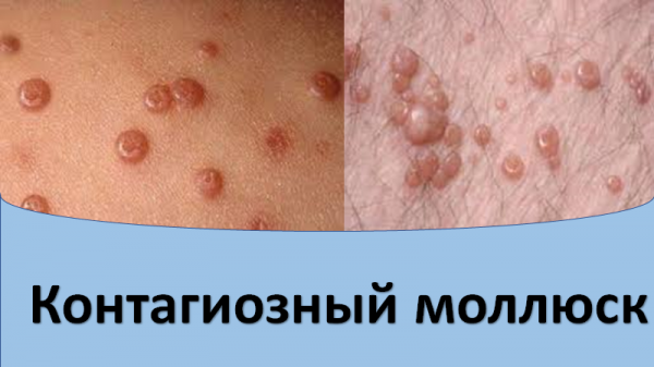 Контагиозный моллюск.