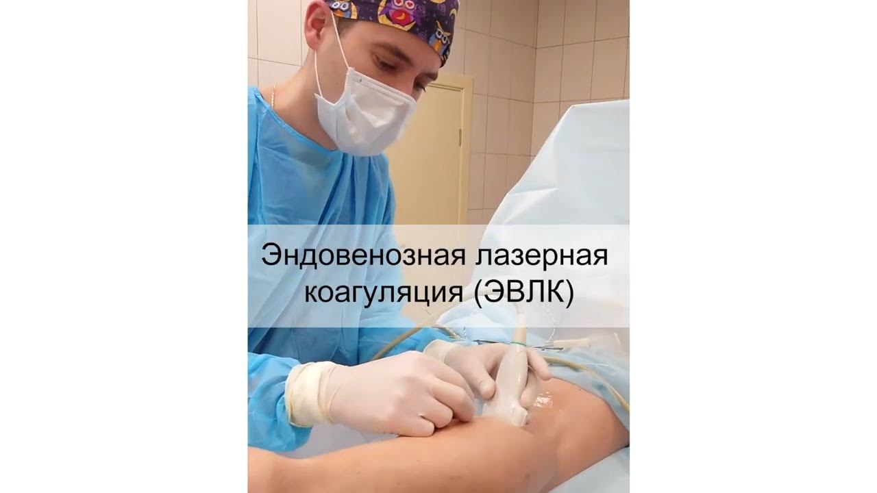 Операция от варикоза лазером - ЭВЛК смотреть онлайн