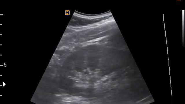 Симптом "перимедуллярного кольца" (11-7-17) смотреть онлайн