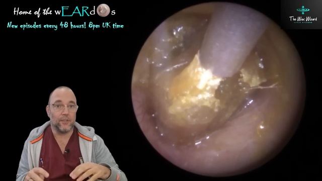 Ear Wax From Prison! 221 #ear #earwax #fyp #foryou #satisfying #asmr #foryourpage #foryoupage