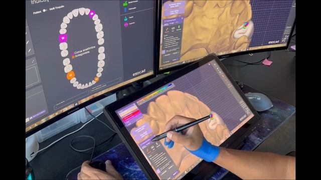 Exocad/ Huion Kanvas смотреть онлайн