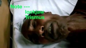 Tetanus Risus sardonicus : A CLINICAL CASE IN MKCG BY ASIM