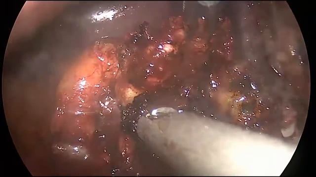 Asvide: Lymph node dissection смотреть онлайн