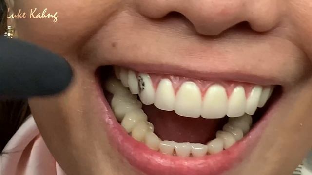 Finalizing a Highly Esthetic Denture with Dentist & Patient In-Lab смотреть онлайн