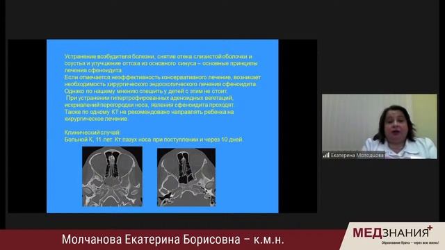 Острые синуситы у детей разных возрастных групп смотреть онлайн