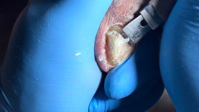 Clean up onychomycosis layer by layer, large deformed nails【Pedicure Master Lin Jun】 смотреть онлайн