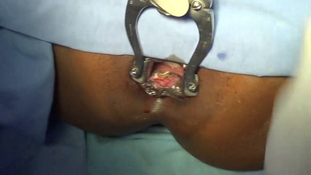 Complex Fissure Surgery Simplified