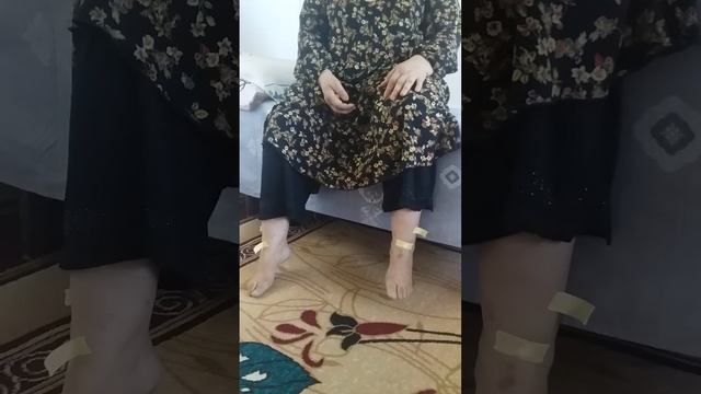 асептический некроз головки бедренной кости. смотреть онлайн