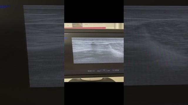 Расширение вен на ногах, но операция не нужна. Флеболог Москва смотреть онлайн