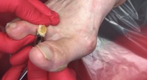 Удаление жёсткой мозоли⚠️????