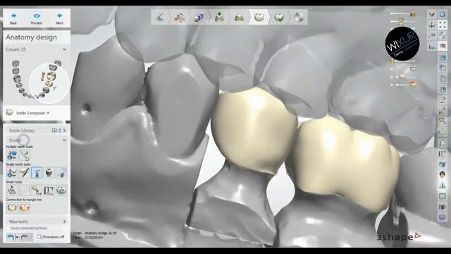 3Shape Tutorial - Full Contour Bridge смотреть онлайн