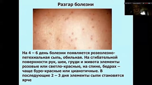 Риккетсиозы. Инфекционные болезни. Бурова С.В. смотреть онлайн