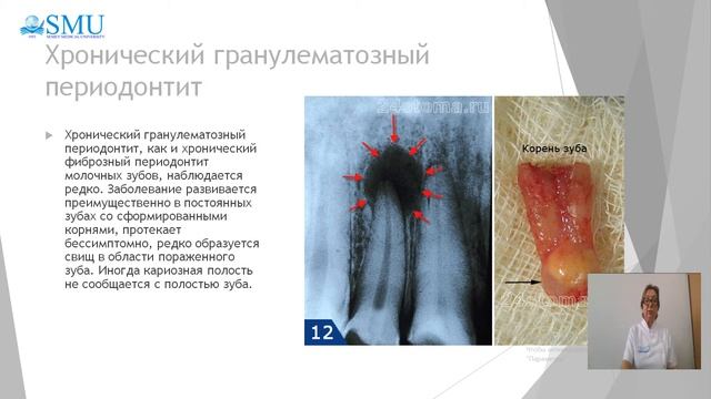 Хронические периодонтиты молочных зубов у детей смотреть онлайн