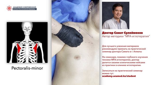 Сухая игла. Pectoralis minor. МАЛАЯ КРУГЛАЯ МЫШЦА. Безопасная постановка иглы. смотреть онлайн