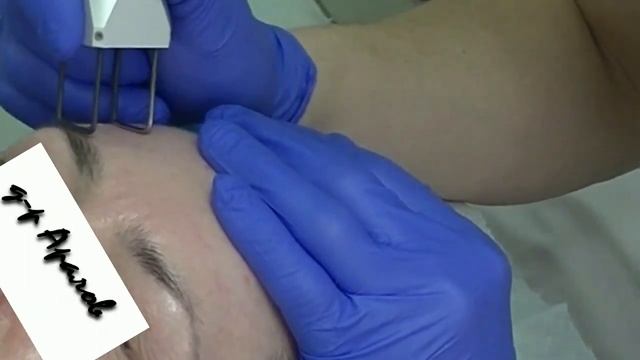 Фракционная лазерная шлифовка лица. Fractional laser face polishing. смотреть онлайн