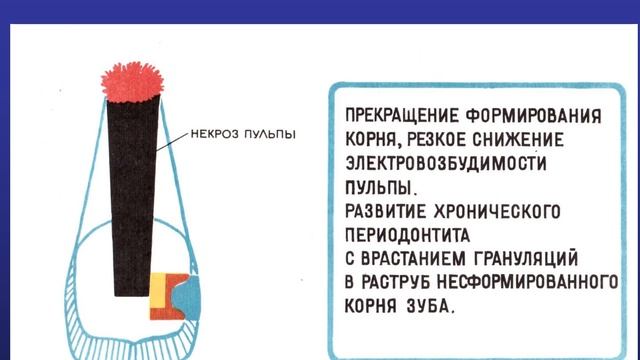 Пульпит постоянных зубов с несформированными корнями смотреть онлайн